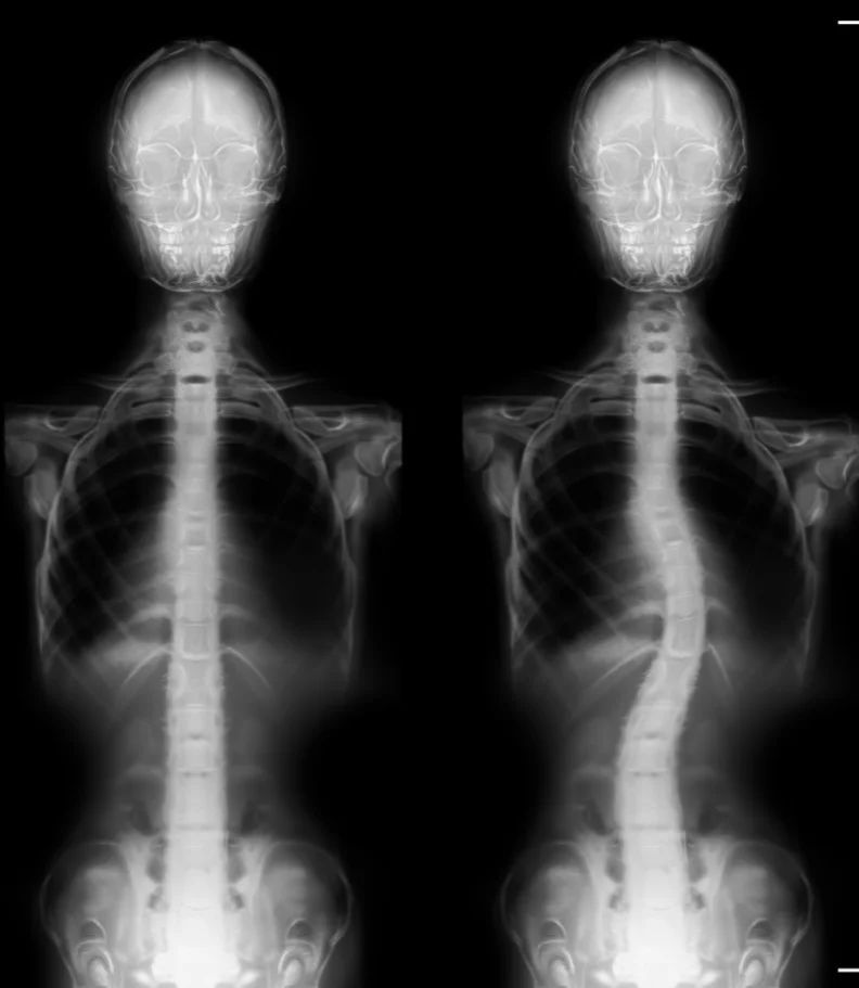 Scoliosis Bellingham